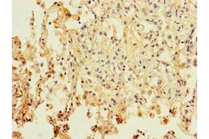 Immunohistochemistry of paraffin-embedded human lung cancer using ABIN7162702 at dilution of 1:100 (PAXIP1 抗体  (AA 613-812))