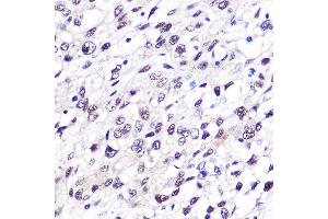 Immunohistochemistry of paraffin-embedded human bladder cancer using FTO Rabbit mAb (ABIN1679842, ABIN3018203, ABIN3018204 and ABIN7101583) at dilution of 1:100 (40x lens). (FTO 抗体)