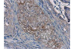 IHC-P Image Interleukin-24 antibody [C2C3], C-term detects Interleukin-24 protein at cytoplasm in human esophageal cancer by immunohistochemical analysis. (IL-24 抗体  (C-Term))