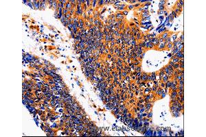 Immunohistochemistry of Human colon cancer using IL18BP Polyclonal Antibody at dilution of 1:50 (IL18BP 抗体)