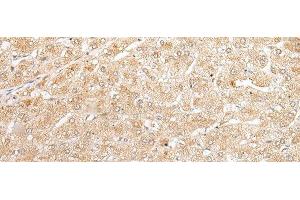 Immunohistochemistry of paraffin-embedded Human liver cancer tissue using NUDT19 Polyclonal Antibody at dilution of 1:25(x200) (NUDT19 抗体)