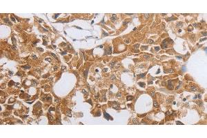 Immunohistochemistry of paraffin-embedded Human lung cancer using MUC20 Polyclonal Antibody at dilution of 1:40 (MUC20 抗体)
