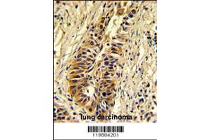 Formalin-fixed and paraffin-embedded human lung carcinoma reacted with TALDO1 Antibody , which was peroxidase-conjugated to the secondary antibody, followed by DAB staining. (TALDO1 抗体  (AA 186-215))