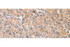 Immunohistochemistry of paraffin-embedded Human liver cancer tissue using STK16 Polyclonal Antibody at dilution of 1:30(x200) (STK16 抗体)