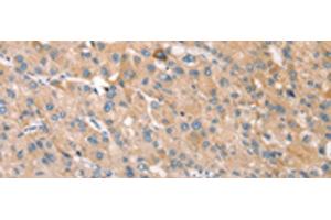 Immunohistochemistry of paraffin-embedded Human liver cancer tissue using STK16 Polyclonal Antibody at dilution of 1:30(x200) (STK16 抗体)