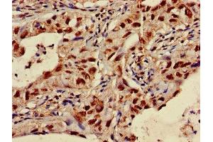 Immunohistochemistry of paraffin-embedded human lung cancer using ABIN7170231 at dilution of 1:100 (SLC35F2 抗体  (AA 335-374))