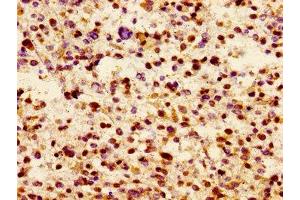 Immunohistochemistry of paraffin-embedded human glioma using ABIN7157174 at dilution of 1:100 (JAM3 抗体  (AA 119-235))