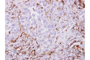 IHC-P Image Iba1 antibody detects Iba1 protein at cytoplasm on human breast cancer stroma by immunohistochemical analysis. (Iba1 抗体)