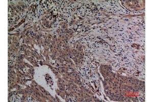 Immunohistochemistry (IHC) analysis of paraffin-embedded Human Breast Cancer, antibody was diluted at 1:100. (MCL-1 抗体  (Internal Region))