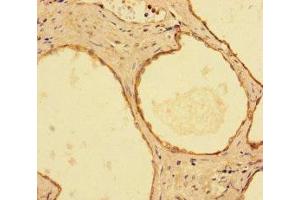 Immunohistochemistry of paraffin-embedded human prostate cancer using ABIN7156292 at dilution of 1:100 (IMPDH2 抗体  (AA 5-514))