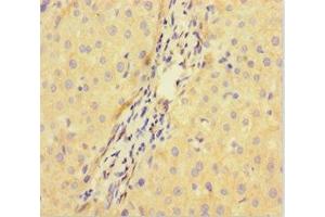 Immunohistochemistry of paraffin-embedded human liver cancer using ABIN7149517 at dilution of 1:100 (DDB1 and CUL4-Associated Factor 1 (DCAF1) (AA 647-745) 抗体)
