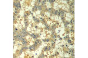 Immunohistochemistry of paraffin-embedded human breast carcinoma using Phospho-SYK-Y323 antibody (ABIN2987845). (SYK 抗体  (pTyr323))