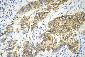 Immunohistochemistry was performed on paraffin-embedded human sigmoid colon carcinoma using catenin beta 1 antibody (ABIN7797926), 1:200). (CTNNB1 抗体)