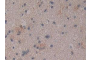 Detection of CD109 in Human Glioma Tissue using Polyclonal Antibody to Cluster Of Differentiation 109 (CD109) (CD109 抗体  (AA 1146-1390))