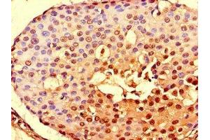 Immunohistochemistry of paraffin-embedded human breast cancer using ABIN7161302 at dilution of 1:100 (NOTCH3 抗体  (AA 1301-1496))