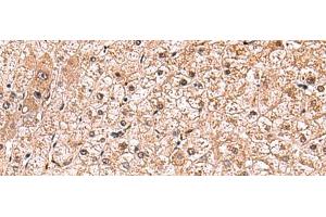 Immunohistochemistry of paraffin-embedded Human liver cancer tissue using RUSC1 Polyclonal Antibody at dilution of 1:90(x200) (RUSC1 抗体)