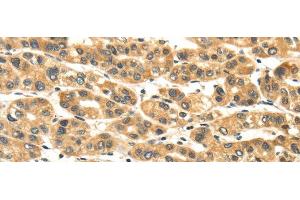Immunohistochemistry of paraffin-embedded Human liver cancer tissue using NME8 Polyclonal Antibody at dilution 1:45 (TXNDC3/NME8 抗体)