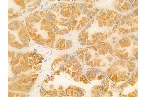 ABIN6256882 and ABIN6274575 at 1/100 staining human renal cell carcinoma by IHC-P.