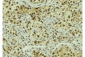 ABIN6267079 at 1/100 staining Human breast cancer tissue by IHC-P. (AC-FKHR 抗体)