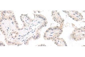Immunohistochemistry of paraffin-embedded Human thyroid cancer tissue using GHDC Polyclonal Antibody at dilution of 1:90(x200) (GHDC 抗体)