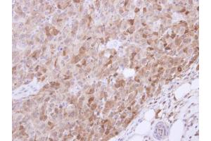 IHC-P Image Immunohistochemical analysis of paraffin-embedded CL1-5 xenograft, using VGAT, antibody at 1:500 dilution. (SLC32A1 抗体  (N-Term))