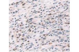 IHC-P analysis of Human Stomach Cancer Tissue, with DAB staining. (TNF alpha 抗体  (AA 77-233))