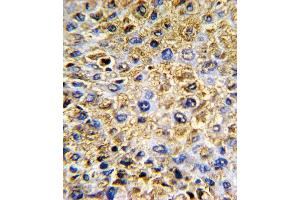 Formalin-fixed and paraffin-embedded human hepatocarcinoma with DCN Antibody (Center), which was peroxidase-conjugated to the secondary antibody, followed by DAB staining. (Decorin 抗体  (AA 122-150))