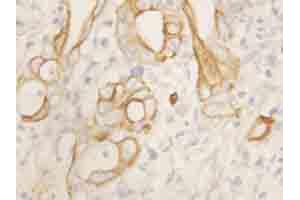 Immunohistochemical staining of TNFRSF1B on formalin fixed, paraffin embedded human intestinal cancer with TNFRSF1B polyclonal antibody . (TNFRSF1B 抗体  (N-Term))