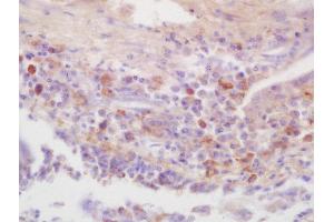 Formalin-fixed and paraffin embedded human lung carcinoma labeled with Rabbit Anti-IRAK4(Thr345) Polyclonal Antibody, Unconjugated (ABIN2177052) at 1:200 followed by conjugation to the secondary antibody and DAB staining (IRAK4 抗体  (pThr345))