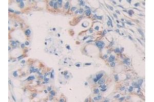 IHC-P analysis of Human Bile duct cancer Tissue, with DAB staining. (KIR2DL2 抗体  (AA 22-348))