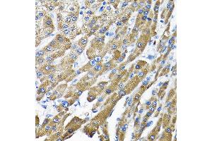 Immunohistochemistry of paraffin-embedded human liver cancer using THUMPD3 Rabbit pAb (ABIN6132951, ABIN6149133, ABIN6149134 and ABIN6214652) at dilution of 1:200 (40x lens). (THUMPD3 抗体  (AA 1-250))