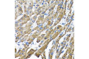 Immunohistochemistry of paraffin-embedded human liver cancer using THUMPD3 Rabbit pAb (ABIN6132951, ABIN6149133, ABIN6149134 and ABIN6214652) at dilution of 1:200 (40x lens). (THUMPD3 抗体  (AA 1-250))