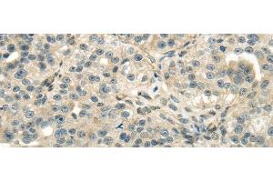 Immunohistochemistry of paraffin-embedded Human breast cancer using DLAT Polyclonal Antibody at dilution of 1/40 (DLAT 抗体)