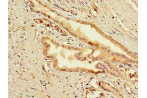 Immunohistochemistry of paraffin-embedded human prostata cancer using ABIN7159849 at dilution of 1:100 (Slc25a1 抗体  (AA 124-162))