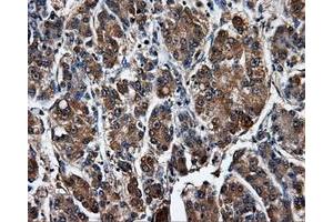 Immunohistochemical staining of paraffin-embedded Carcinoma of liver tissue using anti-SATB1mouse monoclonal antibody. (SATB1 抗体)