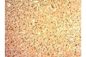 Formalin-fixed, paraffin-embedded human hepatocellular carcinoma stained with Arginase 1 antibody (ARG1/1125). (Liver Arginase 抗体  (AA 1-150))