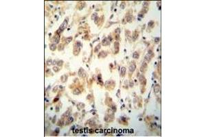 TTC16 antibody (N-term) (ABIN654516 and ABIN2844240) immunohistochemistry analysis in formalin fixed and paraffin embedded human testis carcinoma followed by peroxidase conjugation of the secondary antibody and DAB staining. (TTC16 抗体  (N-Term))