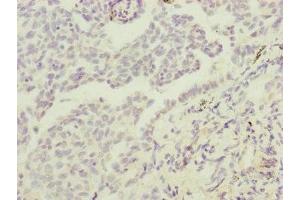 Immunohistochemistry of paraffin-embedded human lung cancer using ABIN7172904 at dilution of 1:100