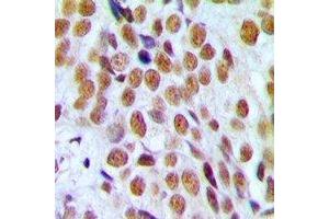 Immunohistochemical analysis of Progesterone Receptor staining in human breast cancer formalin fixed paraffin embedded tissue section. (Progesterone Receptor 抗体)