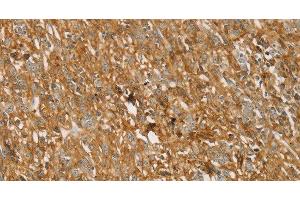 Immunohistochemistry of paraffin-embedded Human gastric cancer using TMPRSS11F Polyclonal Antibody at dilution of 1:30 (TMPRSS11F 抗体)