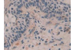 Detection of H2AFY in Human Skin cancer Tissue using Polyclonal Antibody to H2A Histone Family, Member Y (H2AFY)