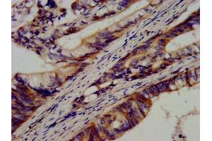 IHC image of ABIN7146245 diluted at 1:600 and staining in paraffin-embedded human colon cancer performed on a Leica BondTM system. (Cadherin 9 抗体  (AA 131-314))