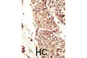 Formalin-fixed and paraffin-embedded human cancer tissue reacted with the primary antibody, which was peroxidase-conjugated to the secondary antibody, followed by AEC staining. (IGF1R 抗体  (C-Term))