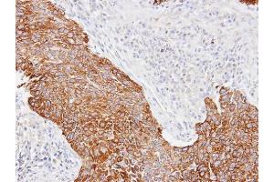 IHC-P Image Immunohistochemical analysis of paraffin-embedded Lung CA, using Cytokeratin 14, antibody at 1:100 dilution. (KRT14 抗体)