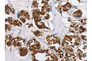 The image on the left is immunohistochemistry of paraffin-embedded Human thyroid cancer tissue using ABIN7129699(HINT2 Antibody) at dilution 1/50, on the right is treated with fusion protein. (HINT2 抗体)