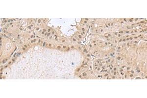 Immunohistochemistry of paraffin-embedded Human thyroid cancer tissue using PCLAF Polyclonal Antibody at dilution of 1:50(x200) (KIAA0101 抗体)
