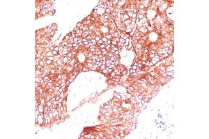 Immunohistochemistry of paraffin-embedded human colon carcinoma using FA antibody (ABIN7267121) at dilution of 1:100 (40x lens). (FAM98A 抗体  (AA 1-220))