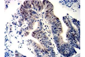 Immunohistochemical analysis of paraffin-embedded colon cancer tissues using WT1 mouse mAb with DAB staining. (WT1 抗体  (AA 1-181))