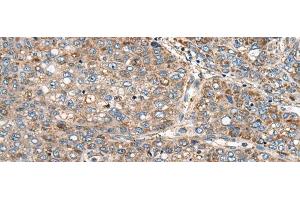 Immunohistochemistry of paraffin-embedded Human liver cancer tissue using CADM2 Polyclonal Antibody at dilution of 1:40(x200) (CADM2 抗体)