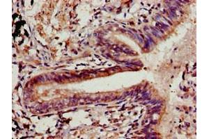 Immunohistochemistry of paraffin-embedded human lung cancer using ABIN7147907 at dilution of 1:100 (Claudin 5 抗体  (AA 181-218))